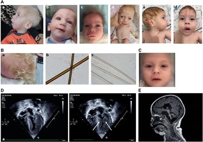 Vici syndrome in Israel: Clinical and molecular insights